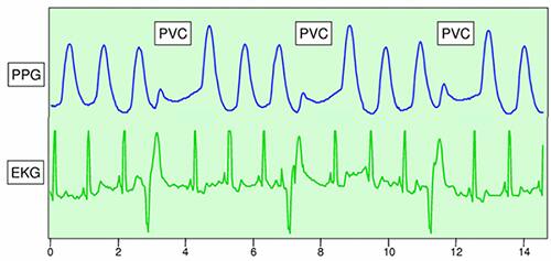 心电图 (EKG) 与光电容积描记图 (PPG) 的对比图片